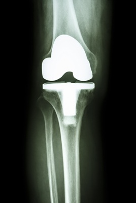 Knee joint prosthesis